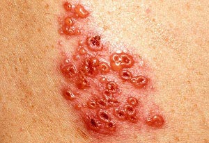 home remedies for shingles